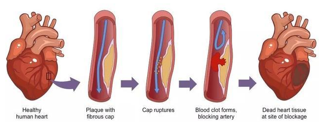 A-Level生物必考动脉粥样硬化，这些知识要点收藏一下！