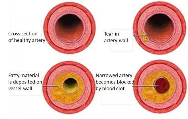 atherosclerosis is multi